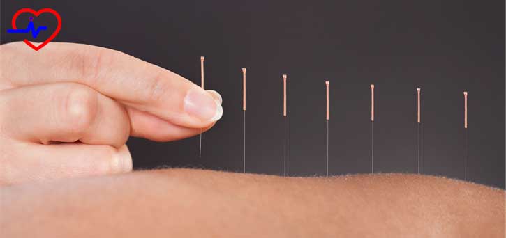 akupunktur-igneleri